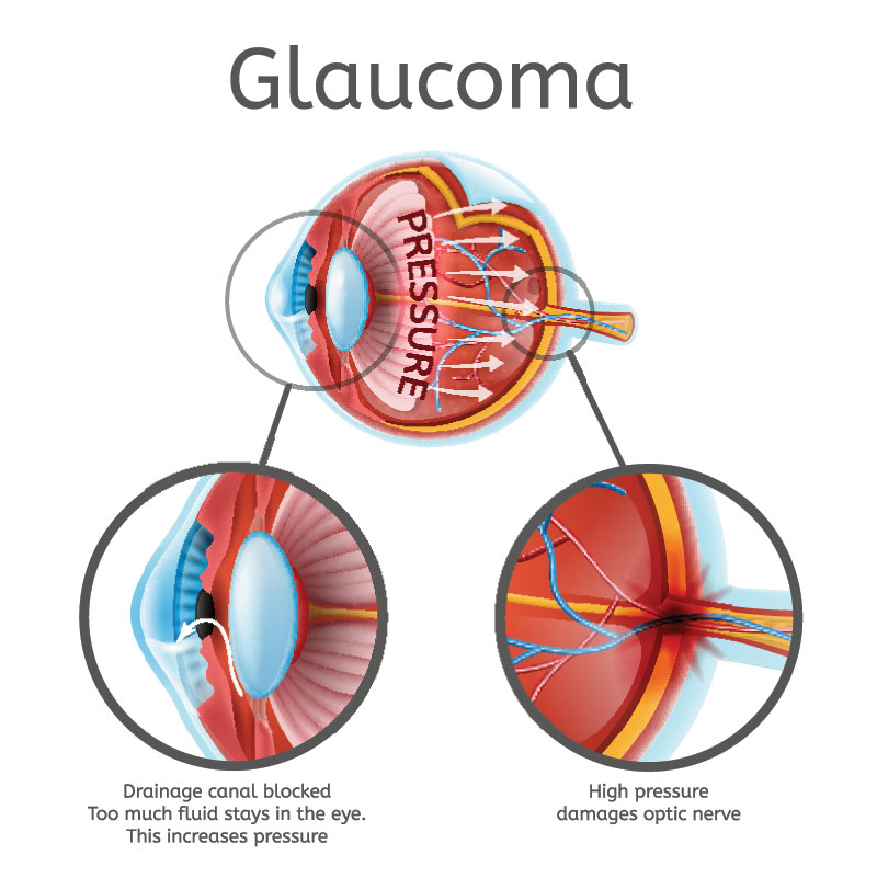 Diagram explaining how glaucoma can be caused and lead to vision loss.