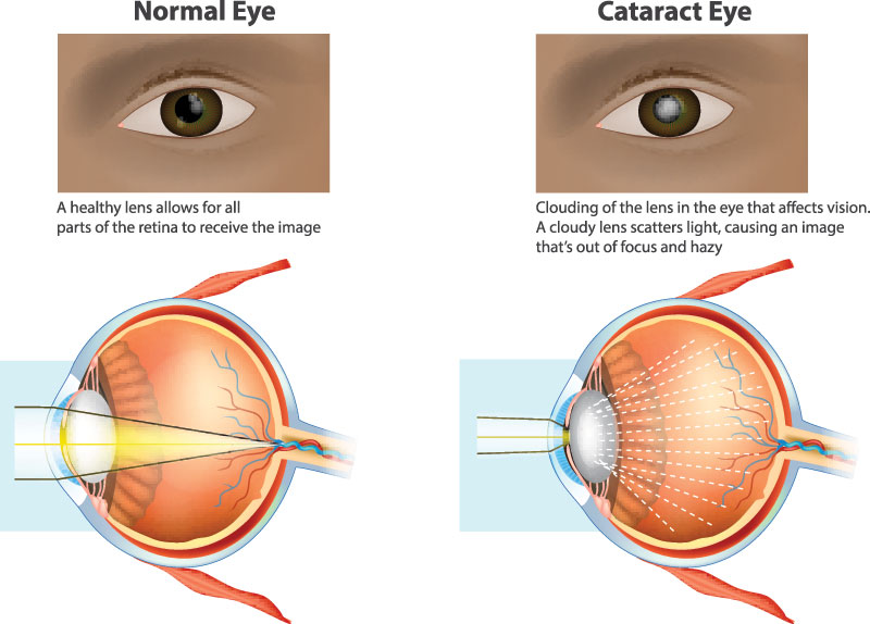 A diagram comparing normal eye health with the effects of cataract, including vision loss.