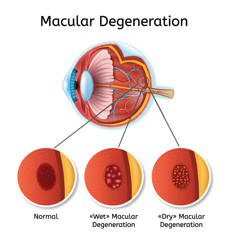 A diagram illustrating the stages of macular degeneration, a condition that progressively leads to vision loss.