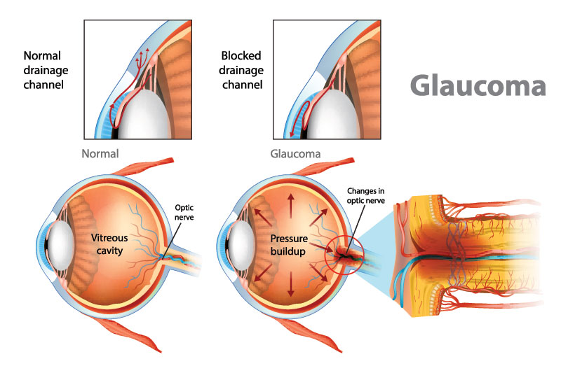 The progressive stages of glaucoma leading to vision loss.