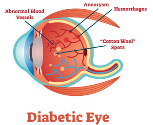 Diabetic retinopathy, a leading cause of vision loss in individuals with diabetes, is a serious eye condition that affects the retina and can lead to diabetic eye complications.