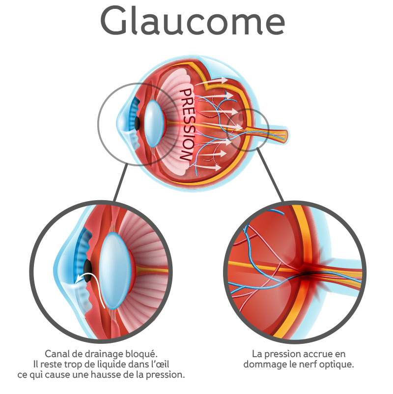 Anatomical-structure-of-the-eye,-showing-glaucoma