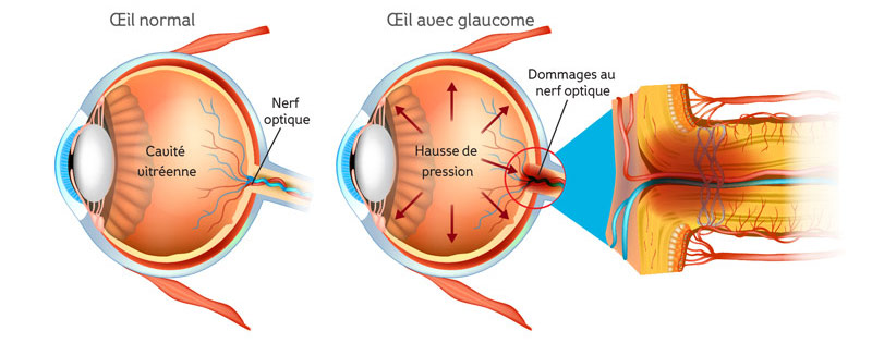 estar impresionado formar controlador Glaucome | Santé oculaire | Voir les possibilités