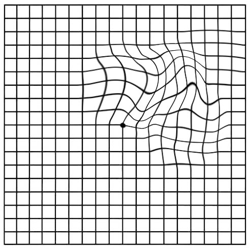 A black and white image of a grid with wavy lines, suitable for eye care professionals reviewing various eye diseases.