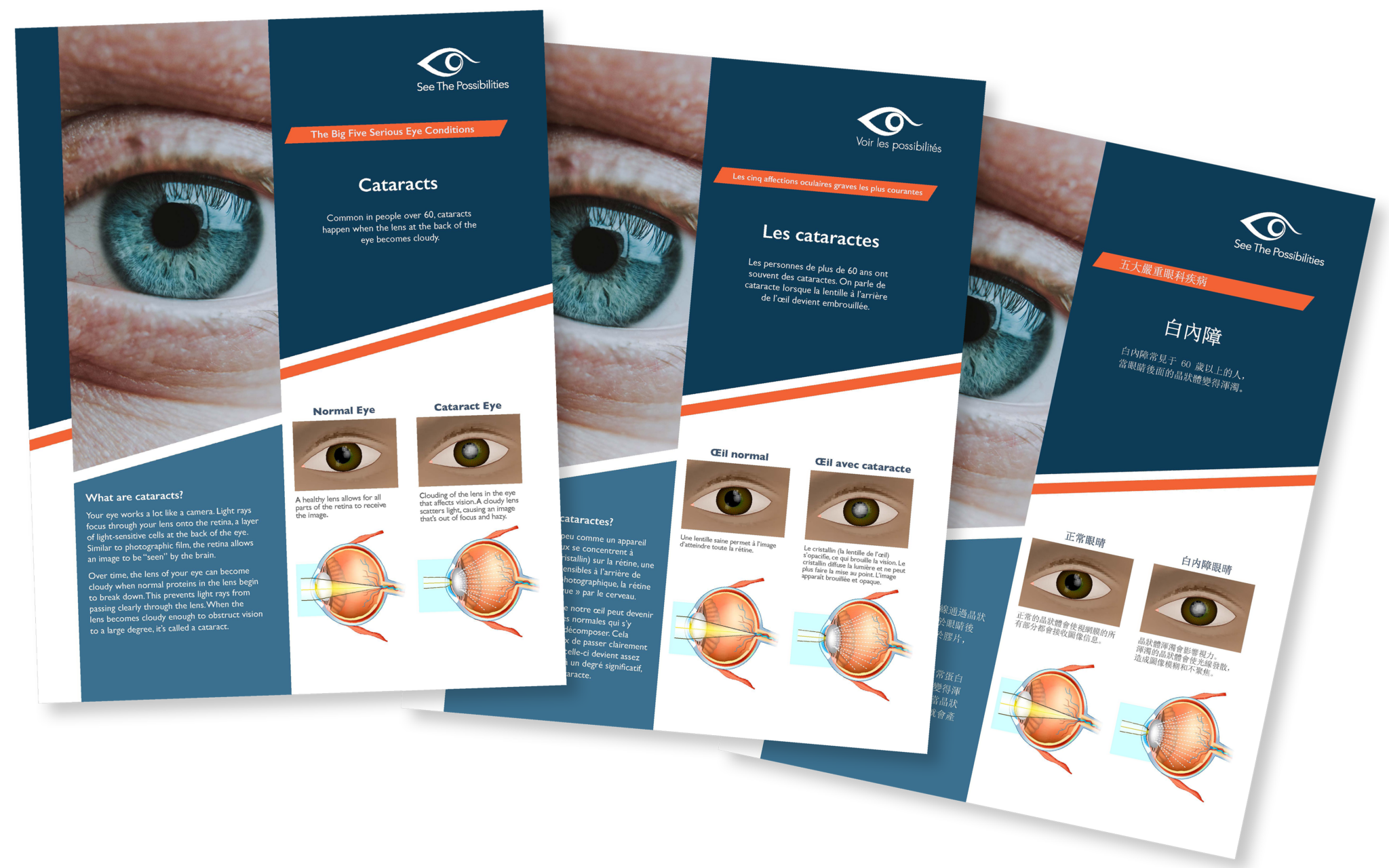 Cataracts | See The Possibilities